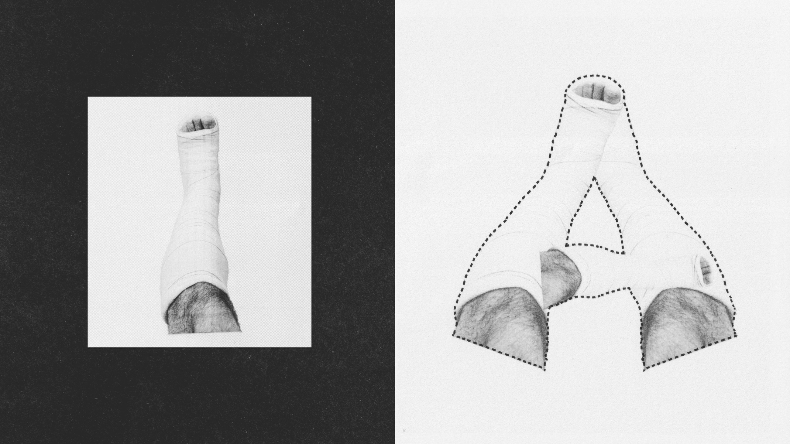 Detail photo of a leg in a cast with a dotted letterform construction diagram